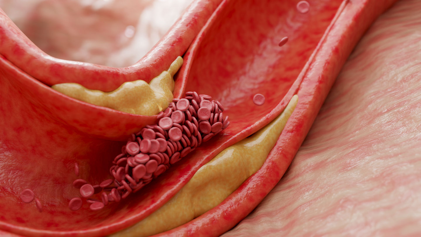 072425_AC_cholesterol_social1.jpg